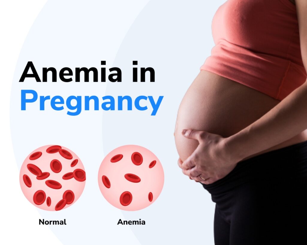 Anemia During Pregnancy